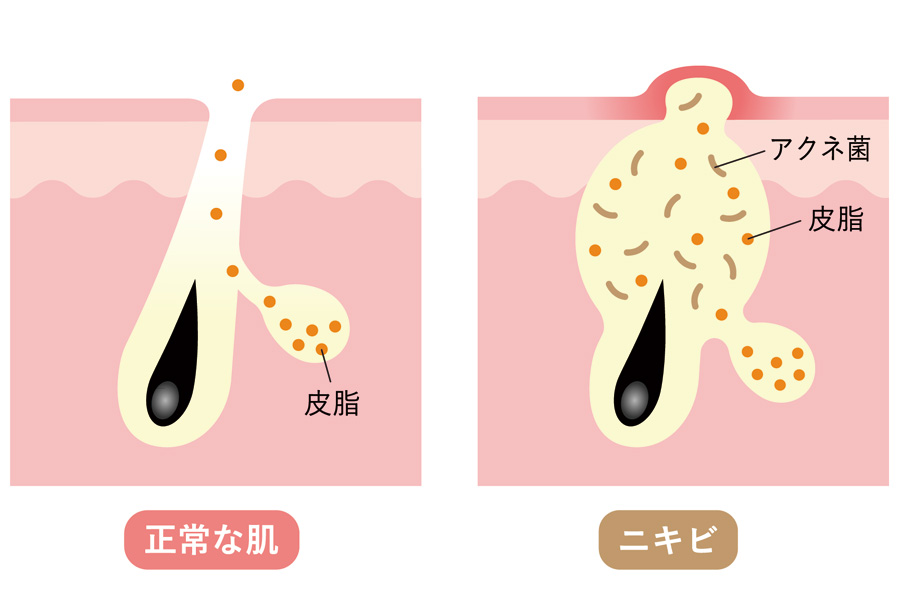 肌トラブルの原因になる