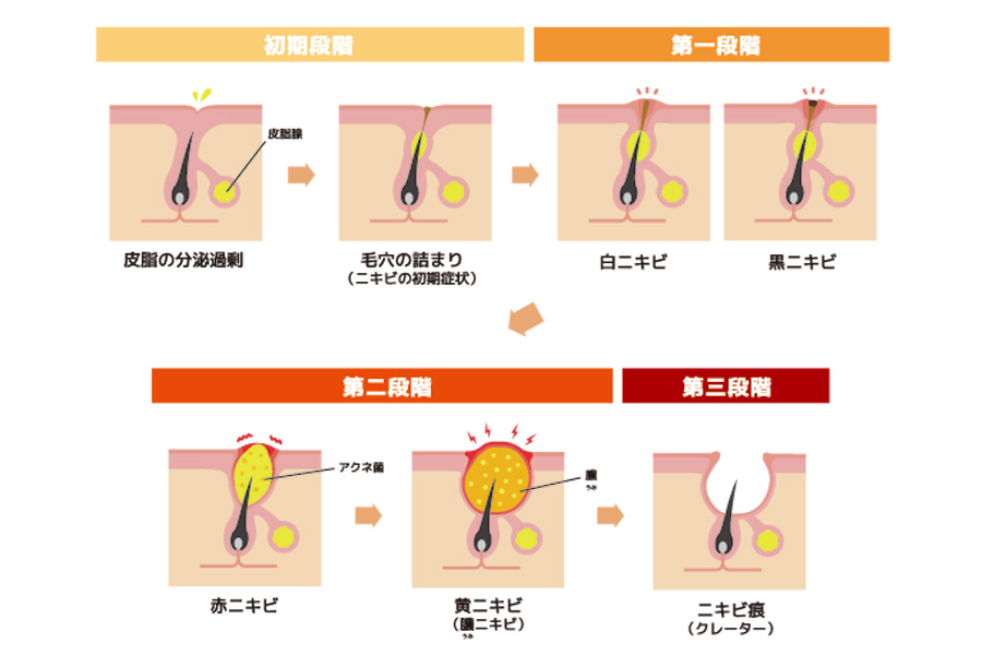 ニキビの種類