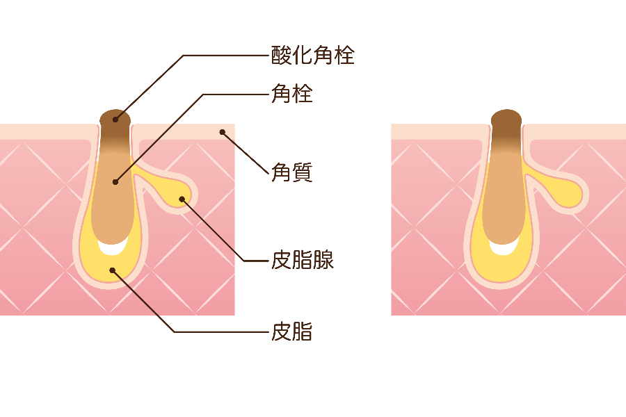 角栓が酸化してさらに毛穴が目立つ