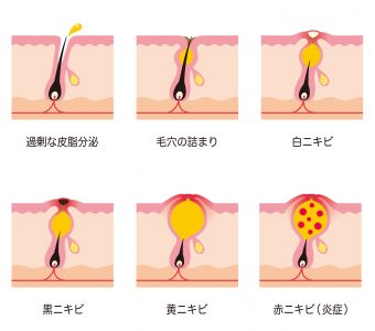 ニキビの種類