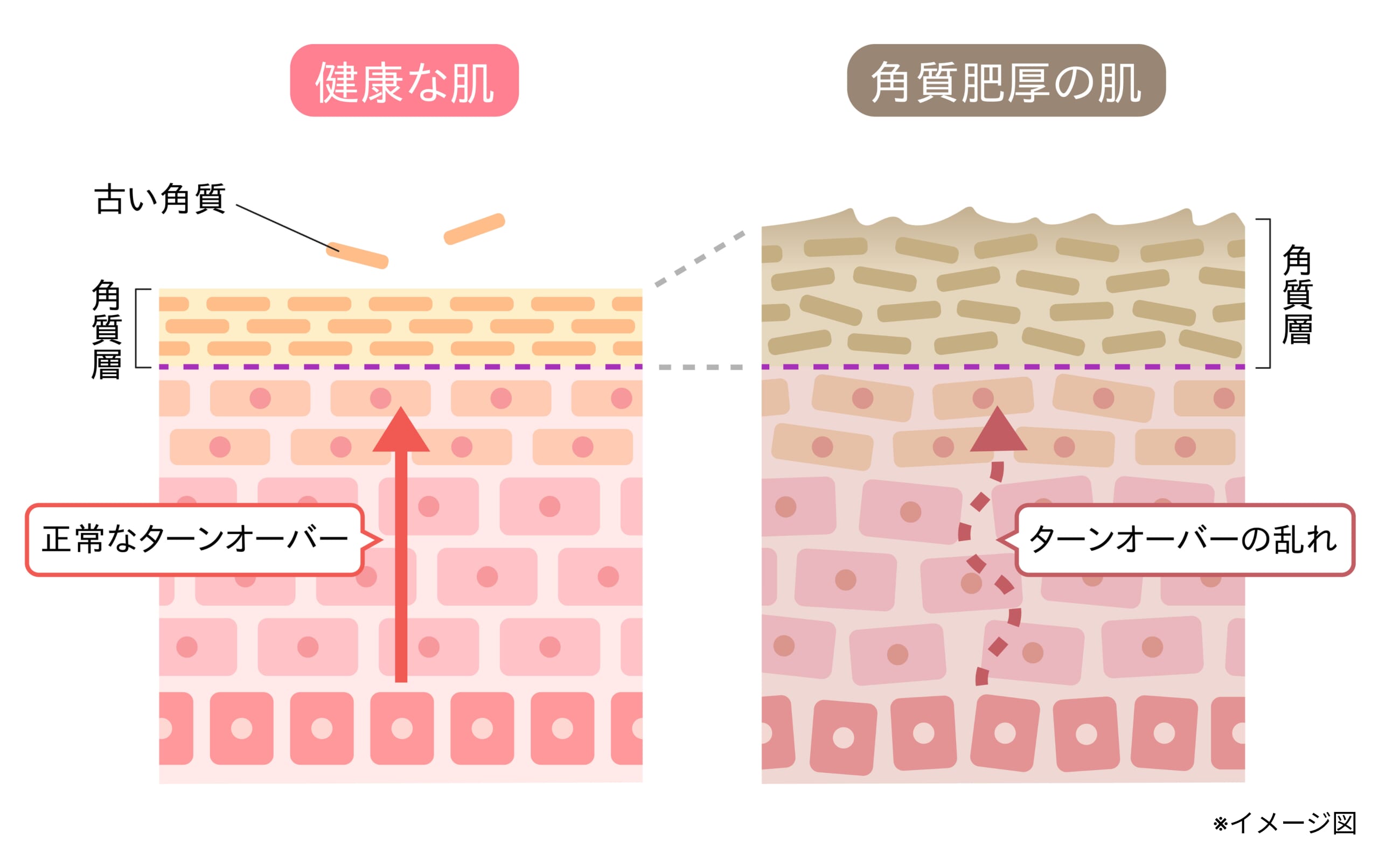 図解_健康な肌と角質肥厚の肌とのターンオーバーの違い